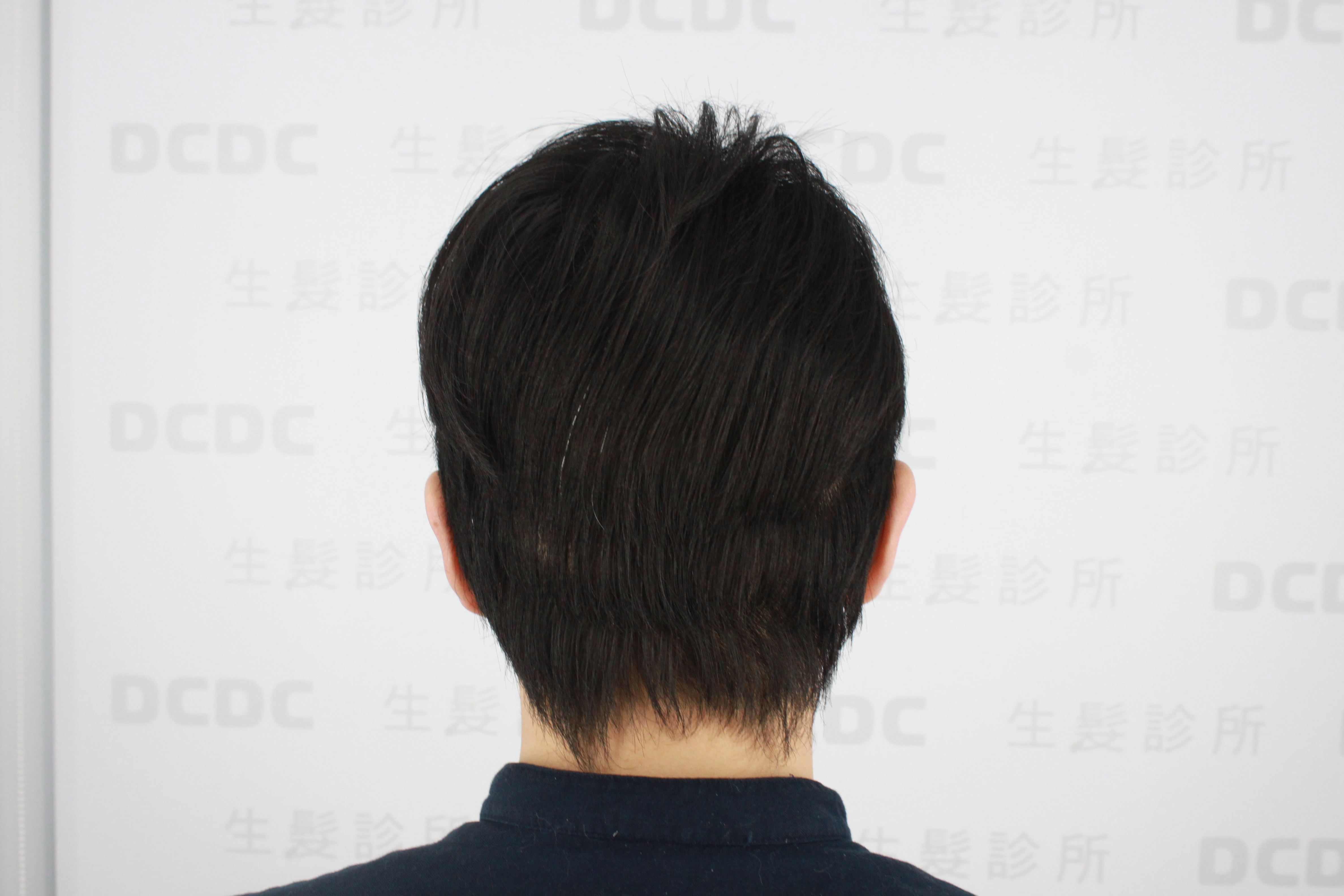 DCDC生髮診所-黃于甄醫師植髮術後隔天前額M型植髮區微創照護